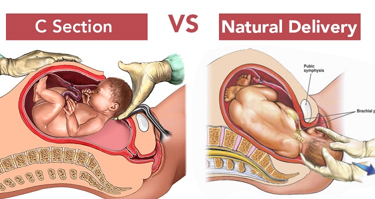 Normal Delivery VS C Section, What To Choose? - Mom Basic
